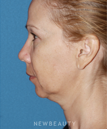 dr-konstantin-vasyukevich-traditional-facelift-b