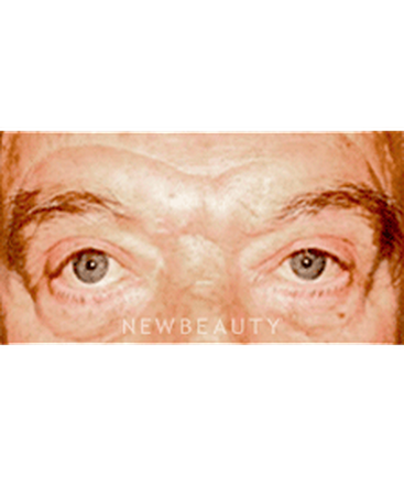dr-sanjay-grover-blepharoplasty-b