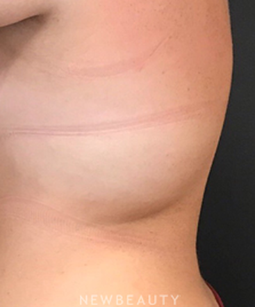 dr-janet-allenby-coolsculpting-b