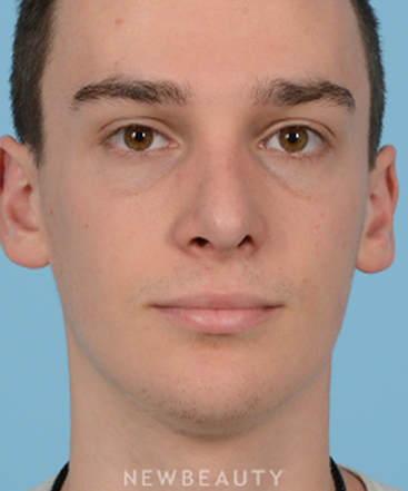 dr-jeffrey-wise-rhinoplasty-b