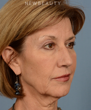 dr-bryan-w-gawley-facial-rejuvenation-b