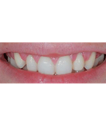 dr-guy-lewis-veneers-b
