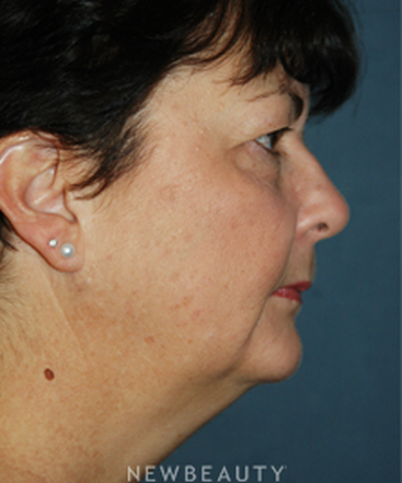 dr-brent-smith-cheekneck-mini-lift-blepharoplasty-b