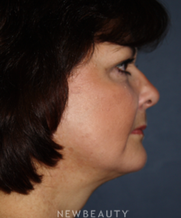dr-brent-smith-cheekneck-mini-lift-blepharoplasty-b