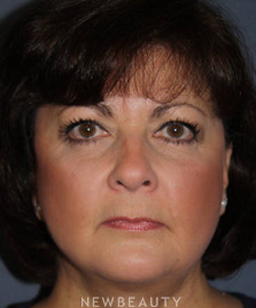 dr-brent-smith-cheekneck-mini-lift-blepharoplasty-b