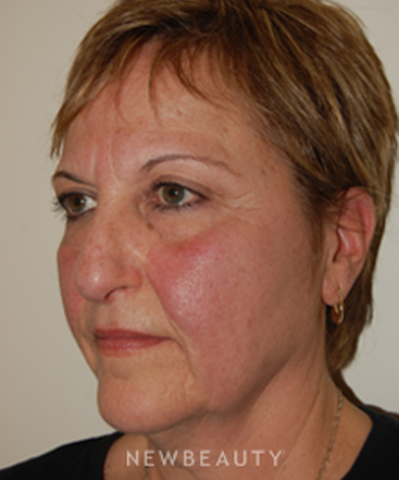 dr-david-rapaport-blepharoplasty-facelift-b