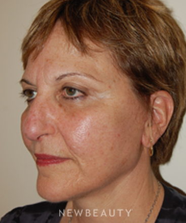 dr-david-rapaport-blepharoplasty-facelift-b