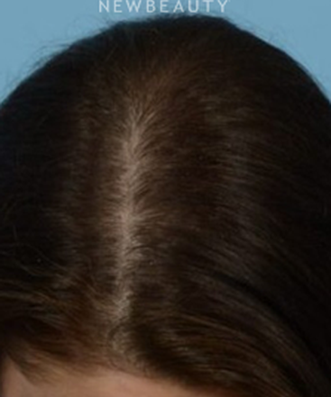 dr-jeffrey-wise-hair-loss-treatment-b