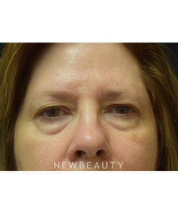 dr-jeffrey-b-wise-blepharoplasty-b