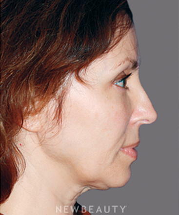 dr-konstantin-vasyukevich-facelift-necklift-b
