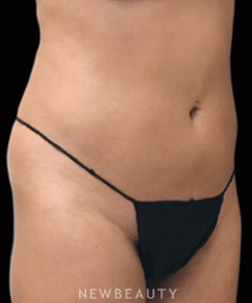 dr-janet-allenby-coolsculpting-b