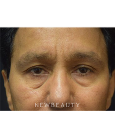 dr-jeffrey-b-wise-lower-blepharoplasty-b
