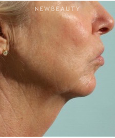 dr-marina-peredo-firmatherapy-for-sagging-skin-b
