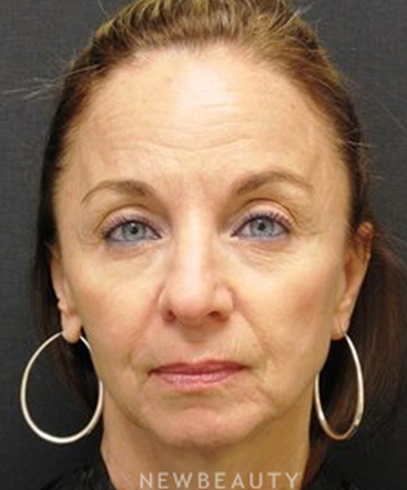 dr-janet-allenby-botox-b