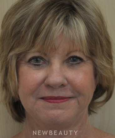 dr-andrew-smith-facelift-eyelift-necklift-b