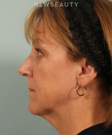 dr-kenneth-beer-kybella-b