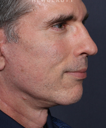 ljcsc-dr-brahme-facelift-b