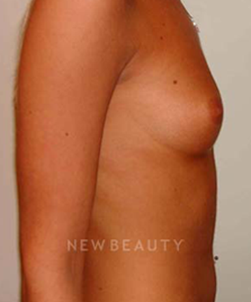 dr-michael-horn-saline-breast-implants-b