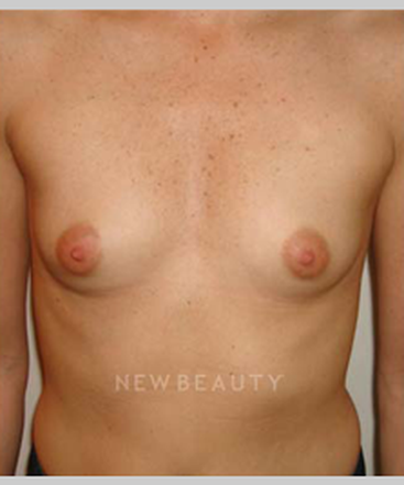 dr-michael-horn-silicone-breast-implants-b