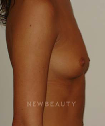 dr-michael-horn-silicone-breast-implants-b