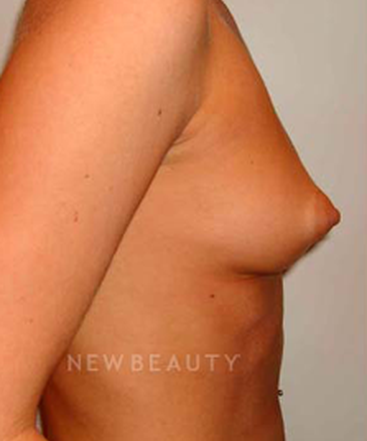 dr-michael-horn-breast-augmentation-b