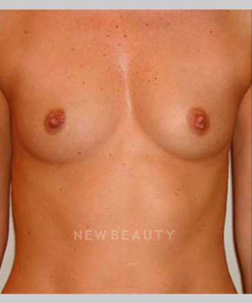 dr-michael-horn-silicone-breast-implants-b