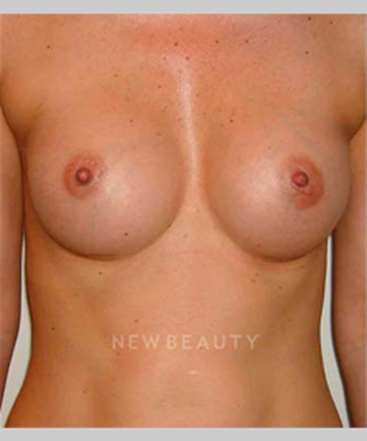 dr-michael-horn-silicone-breast-implants-b