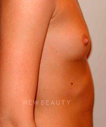 dr-michael-horn-saline-breast-implants-b