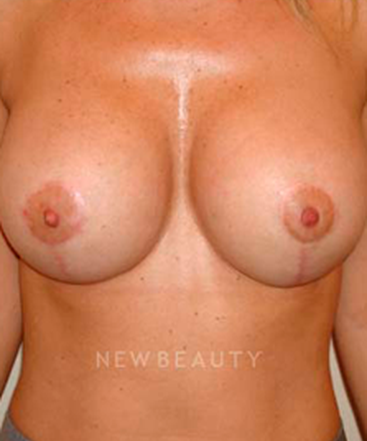 dr-michael-horn-breast-lift-b