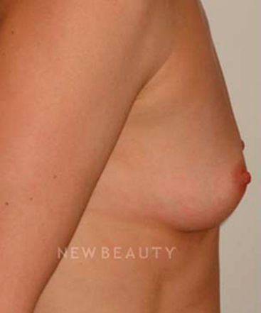 dr-michael-horn-breast-augmentation-b