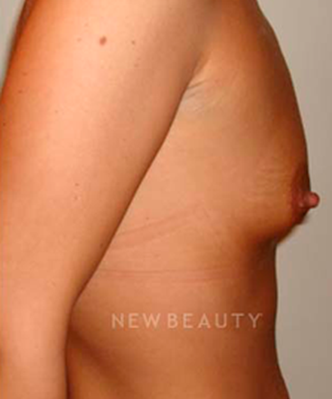 dr-michael-horn-saline-breast-implants-b