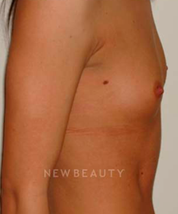 dr-michael-horn-silicone-breast-implants-b