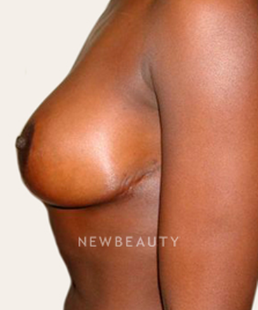 dr-michael-horn-breast-lift-b