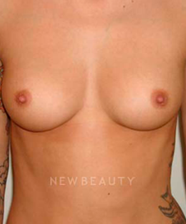 dr-michael-horn-silicone-breast-implants-b