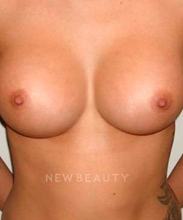 dr-michael-horn-silicone-breast-implants-b