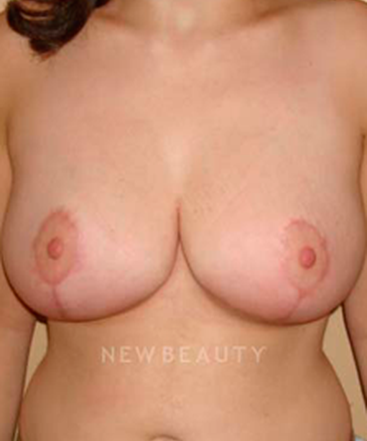 dr-michael-horn-breast-reduction-b