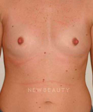 dr-michael-horn-silicone-breast-implants-b