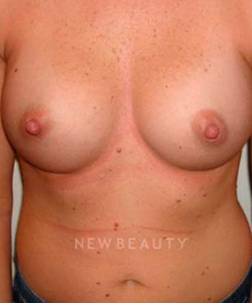 dr-michael-horn-silicone-breast-implants-b