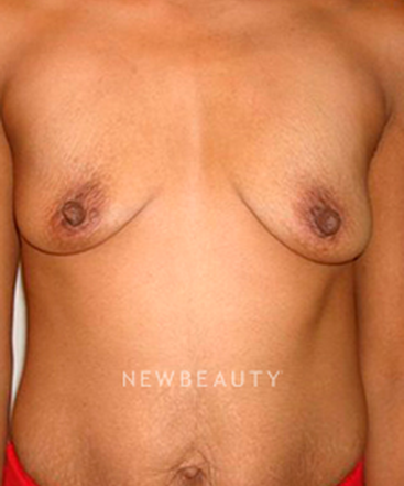 dr-michael-horn-breast-augmentation-b