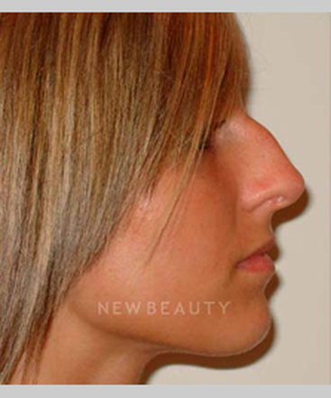 dr-michael-horn-rhinoplasty-b