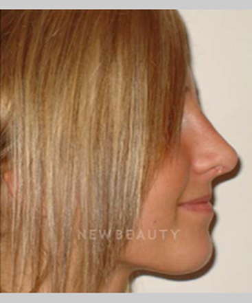 dr-michael-horn-rhinoplasty-b