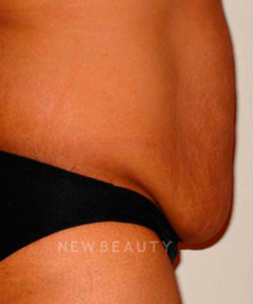 dr-michael-horn-tummy-tuck-b