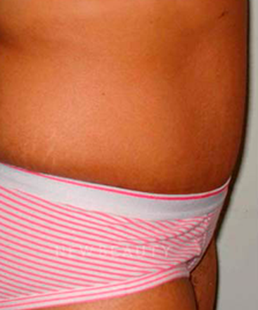 dr-michael-horn-tummy-tuck-b