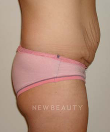 dr-michael-horn-tummy-tuck-b