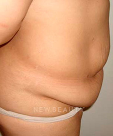 dr-michael-horn-tummy-tuck-b