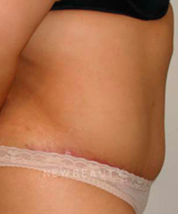 dr-michael-horn-tummy-tuck-b
