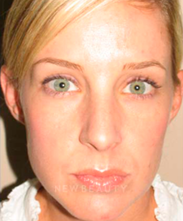 dr-sanjay-grover-rhinoplasty-b
