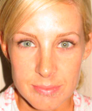 dr-sanjay-grover-rhinoplasty-b
