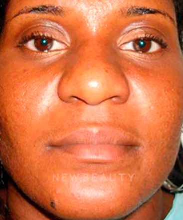dr-michael-horn-rhinoplasty-b