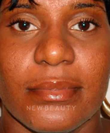 dr-michael-horn-rhinoplasty-b